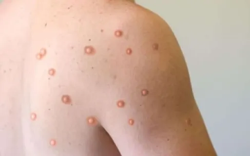 طبيب يقيّم خطورة جدري الماء