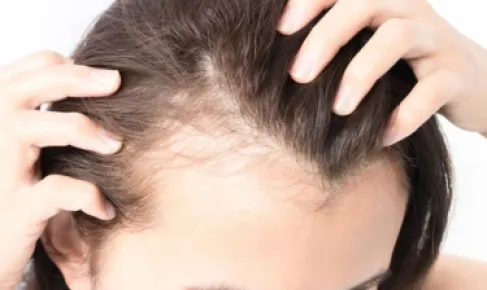 تساقط الشعر عند النساء.. أطباء يوضحون الأسباب والحلول