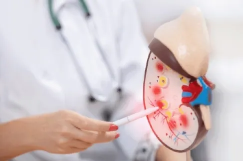 تحذير طبي: حصوات الكلى قد تمر بلا أعراض قبل أن تفاجئك