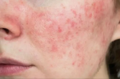 رغم نجاح التجارب.. أمريكا ترفض علاج أسترازينيكا لمرض الذئبة