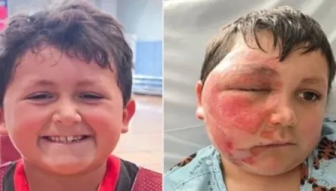 كارثة تيك توك.. صرخة أم بعد إصابة طفلها بحروق خطيرة بسبب تحدي الميكروويف