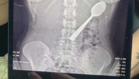 امرأة تبتلع ملعقة طولها 17 سنتيمتراً عن طريق الخطأ