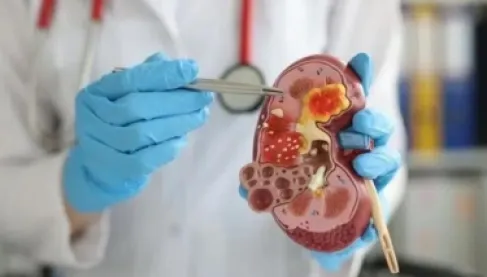 Innovative treatment opens new horizons in combating kidney cancer