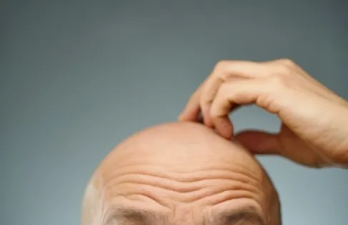 Good News for Men: Topical Baldness Treatment Stimulates Hair Growth by 500%