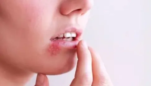 اختراق علمي غير مسبوق لتعطيل فيروس القُبَل