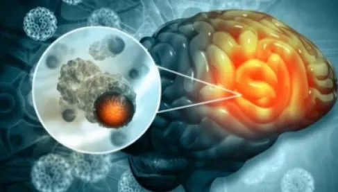 جسيمات نانوية ذكية.. سلاح علمي جديد ضد سرطان الدماغ