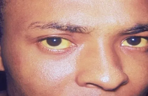 البشرة مرآة صحة الجسم.. كيف تكشف عن مشاكل المرارة؟