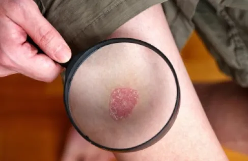 اكتشاف طريقة فعّالة لتقليل أعراض الصدفية