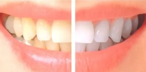 لن تتوقعها.. 6 أطعمة مفاجئة تحمي أسنانك