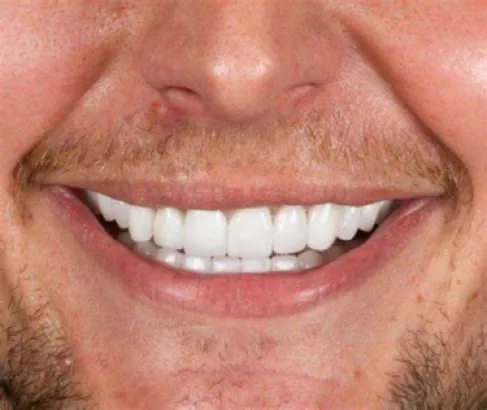 7 حقائق عليك معرفتها قبل تركيب (ابتسامة هوليوود)