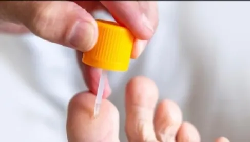 Hand and Foot Warts.. Your Practical Guide to Handling Them