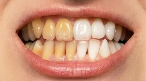 خطأ (غير متوقع) مع القهوة يسبب تصبغ الأسنان