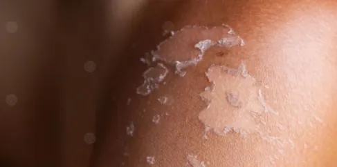 Common antidepressant causes skin erosion in a woman by 55%