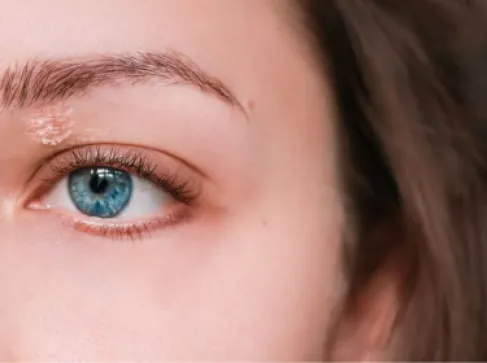 مضاد اكتئاب شائع يتسبب في تآكل جلد امرأة بنسبة 55%