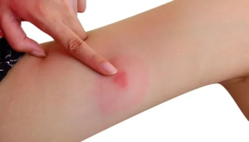 بـ(الحرارة).. طريقة تتفوق على الأدوية لعلاج لدغات البعوض