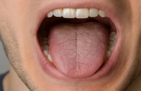 أمراض خطيرة تختبئ وراء جفاف الفم