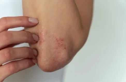 ما علاقة الجلد باضطراب النوم والذاكرة؟!