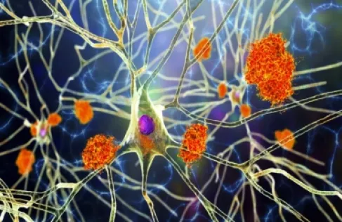 اكتشاف سبب تدهور الذاكرة السريع لدى مرضى ألزهايمر