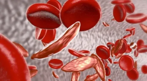 19 حزيران.. فهم شامل لمرض الخلايا المنجلية