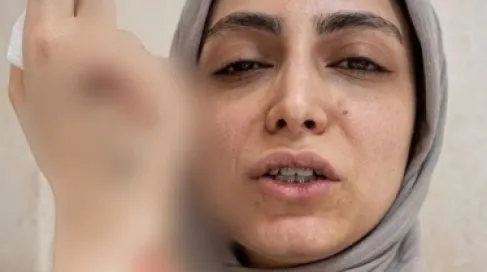 كسر مضاعف وجراحة.. اعتداء على طبيبة أسنان يهز الأوساط الطبية في مصر