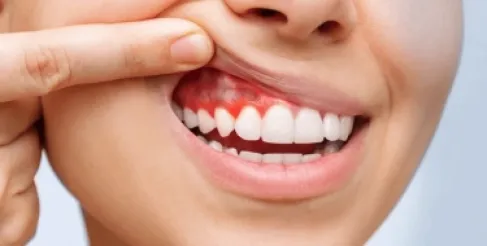 الصيام المتقطع قد يساعد في علاج أمراض اللثة