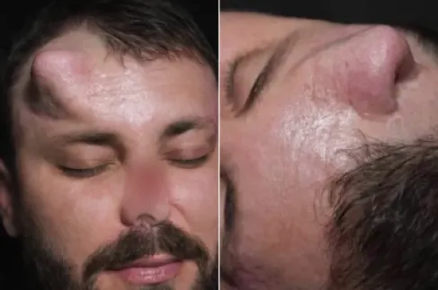 جرّاح عراقي يعيد بناء أنف في جبين مريض