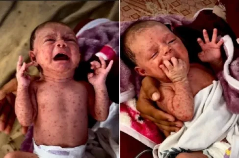جدري الماء ينهش أجساد أطفال غزة