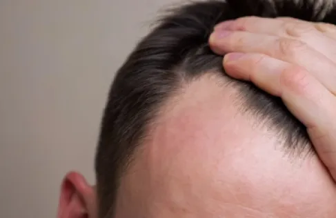 أدوية إنقاص الوزن قد ترتبط بتساقط الشعر لدى الرجال