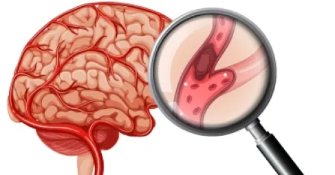 الجلطة الدماغية لا تعرف العمر.. حالات سجلت لدى أطفال بعمر 6 سنوات