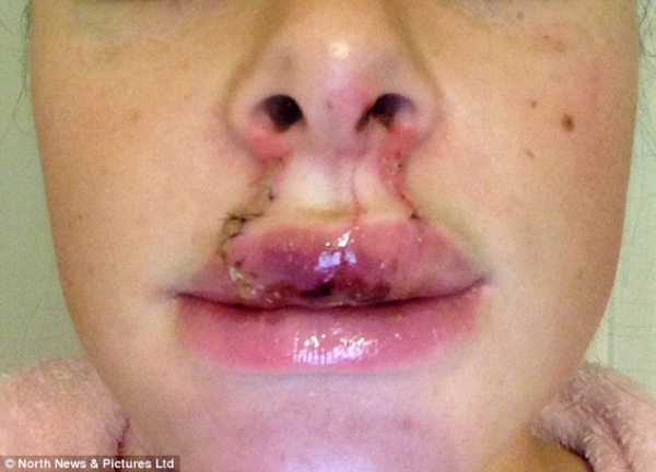 قطع شفتي حبيبته بسبب الغيرة - صور