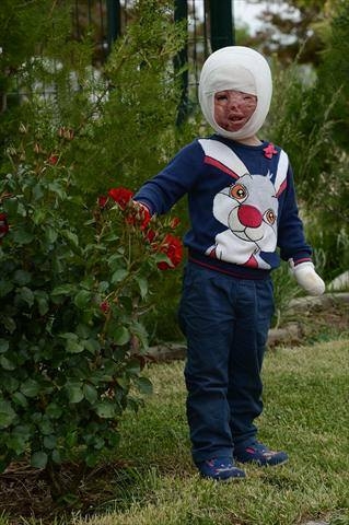 نار الحرب شوهت وجه جنى - صور