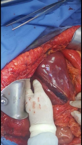 أسرع زراعة كبد في الأردن - صور